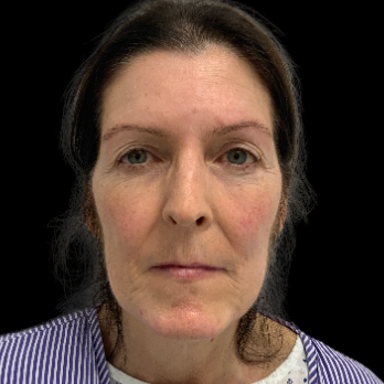 before-deep-plane-facelift-necklift-liplift-nanofat